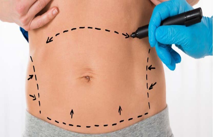 Liposuction Is Holistic